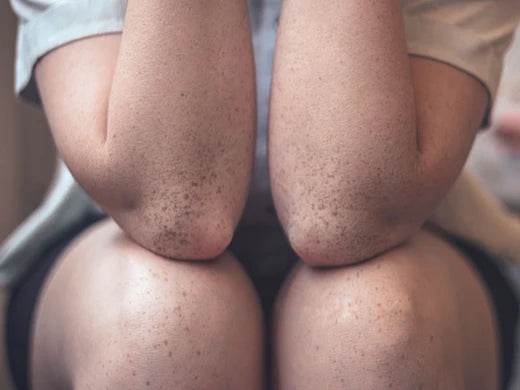 Eczema: How Beef Organ Meats Can Support Eczema Management